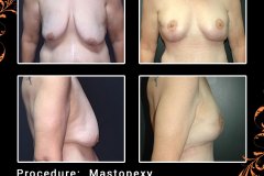 mastopexy-3586