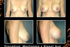 mastopexy-3930