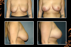 mastopexy-4154