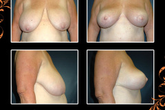 mastopexy-4898