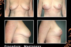 mastopexy-5234