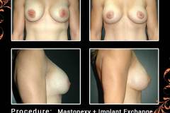 mastopexy-5353