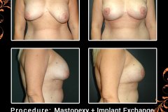 mastopexy-5847