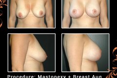 mastopexy-5989