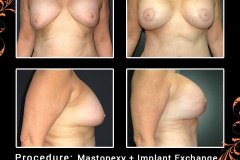 mastopexy-6225