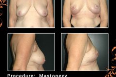mastopexy-6425