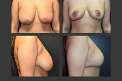 3_breast reduction