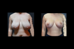 Breast-Reduct
