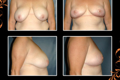 BreastRedux-1363