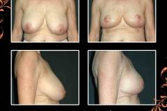 BreastRedux-6642