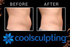 coolsculpting-1