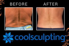 coolsculpting-2