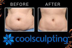 coolsculpting-3
