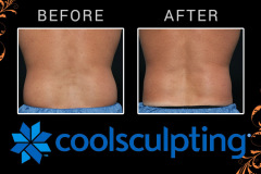 coolsculpting-4