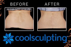 coolsculpting-5