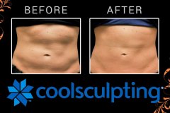 coolsculpting-6