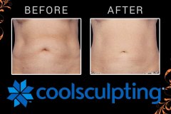 coolsculpting-7