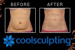 coolsculpting-8