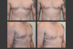 13_gynecomastia