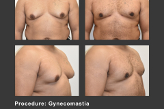 17_gynecomastia