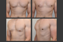 21_gynecomastia