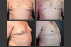 25_gynecomastia