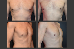 30_gynecomastia