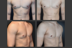 31_gynecomastia