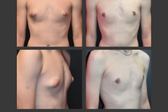 42_gynecomastia