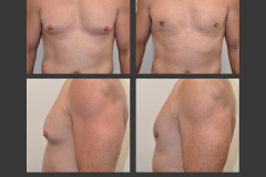 6_gynecomastia