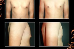 Gynecomastia-6490-b