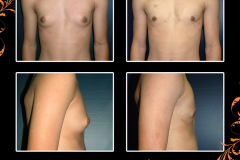 gynecomastia-0450