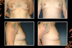 gynecomastia-0479
