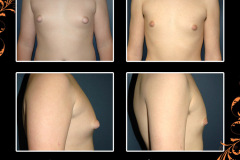 gynecomastia-0693
