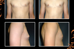 gynecomastia-0771