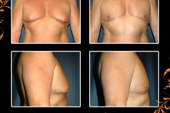 gynecomastia-2693