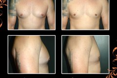 gynecomastia-6058