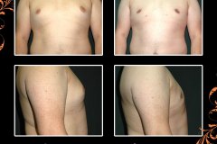 gynecomastia-63778