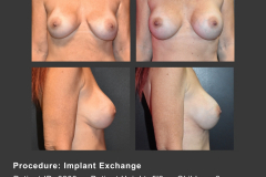 34_implant exchange