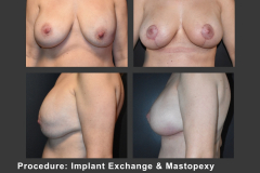 43_implant exchnge and mastopexy
