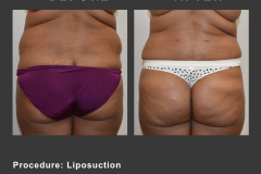 18_lipo
