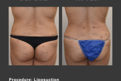 2_lipo