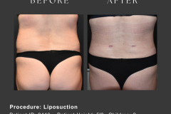 4_liposuction
