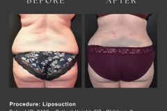 5_liposuction
