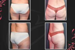MAZ_BeforeAfter_Liposuction_3887