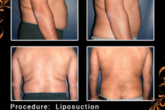 lipo-0438_1