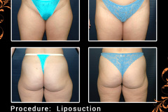 lipo-0584_1