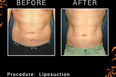 lipo-0700_1