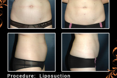 lipo-0716_1