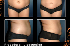 lipo-1927_1